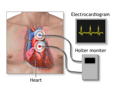 HOLTER-MONITOR